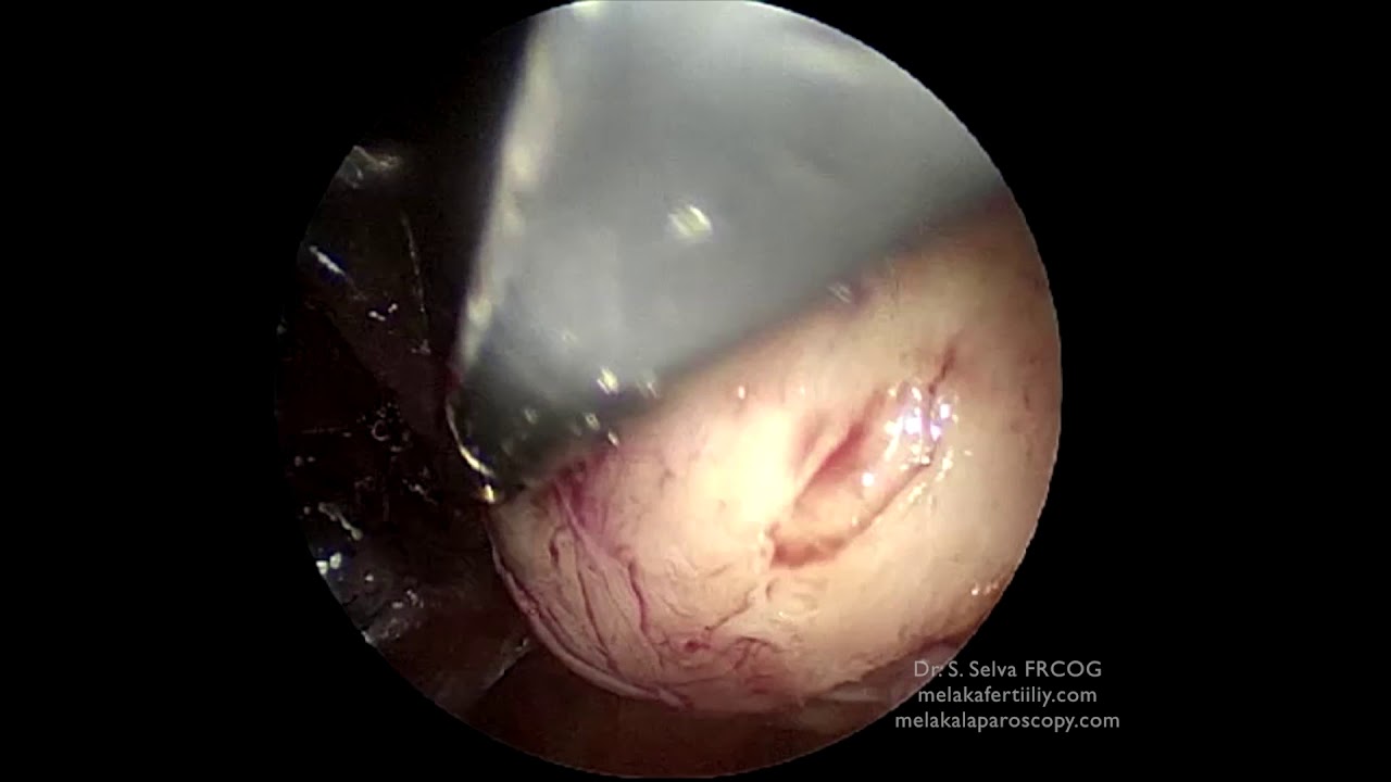 Single incision laparoscopic surgery using the Hakko E-Z Acess port