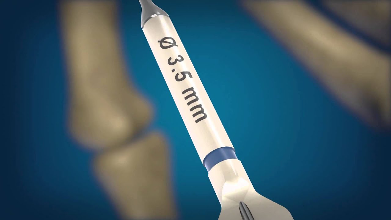 DG Medical Animations: REDUCT Headless Compression Screw