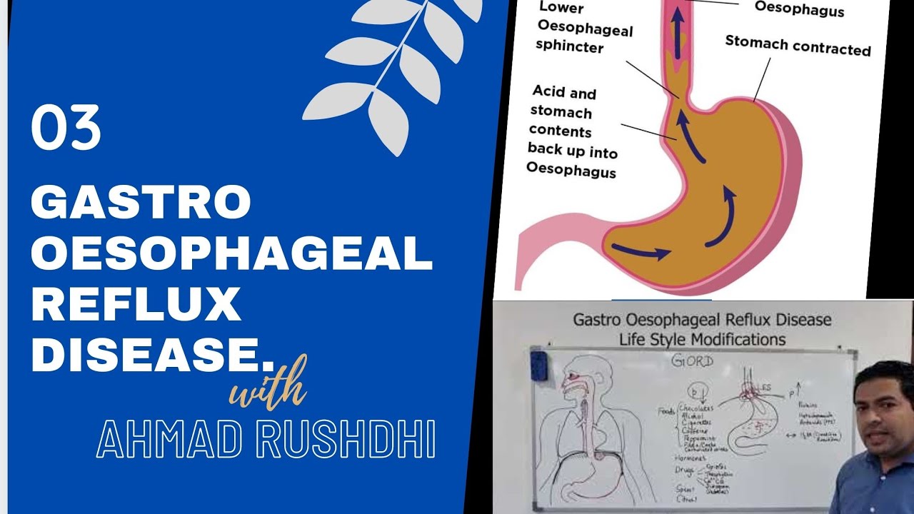 GASTRO OESOPHAGEAL REFLUX DISEASE AND LIFESTYLE MODIFICATIONS #GERD# #GORD# #Heartburn# #Reflux#