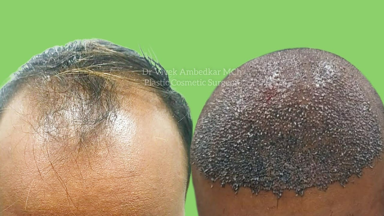 Hair Transplant Surgery Rewa Satna Jabalpur Prayagraj Varanasi Mirzapur Damoh Katni Jhansi