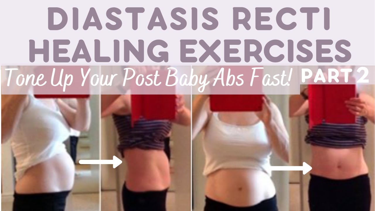 Diastasis Recti Healing Exercises Part 2 (TONE UP YOUR POST BABY ABS FAST)  