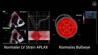 〖Echocardiografie〗Normaler Strain des LV - APLX & Bullseye 🎯🫀