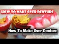 How to make Over Dentures