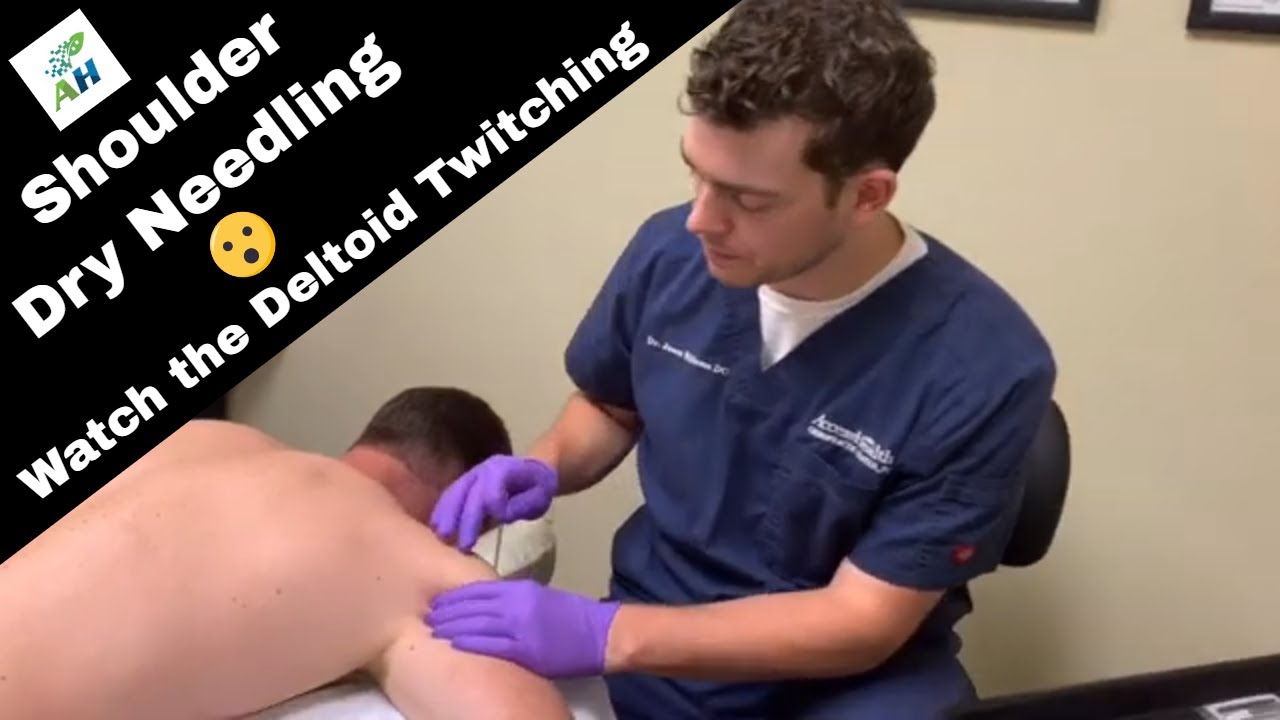 Иглоукалывание для купирования мышечных подергиваний плеча | Посмотрите, как подергивается дельто...