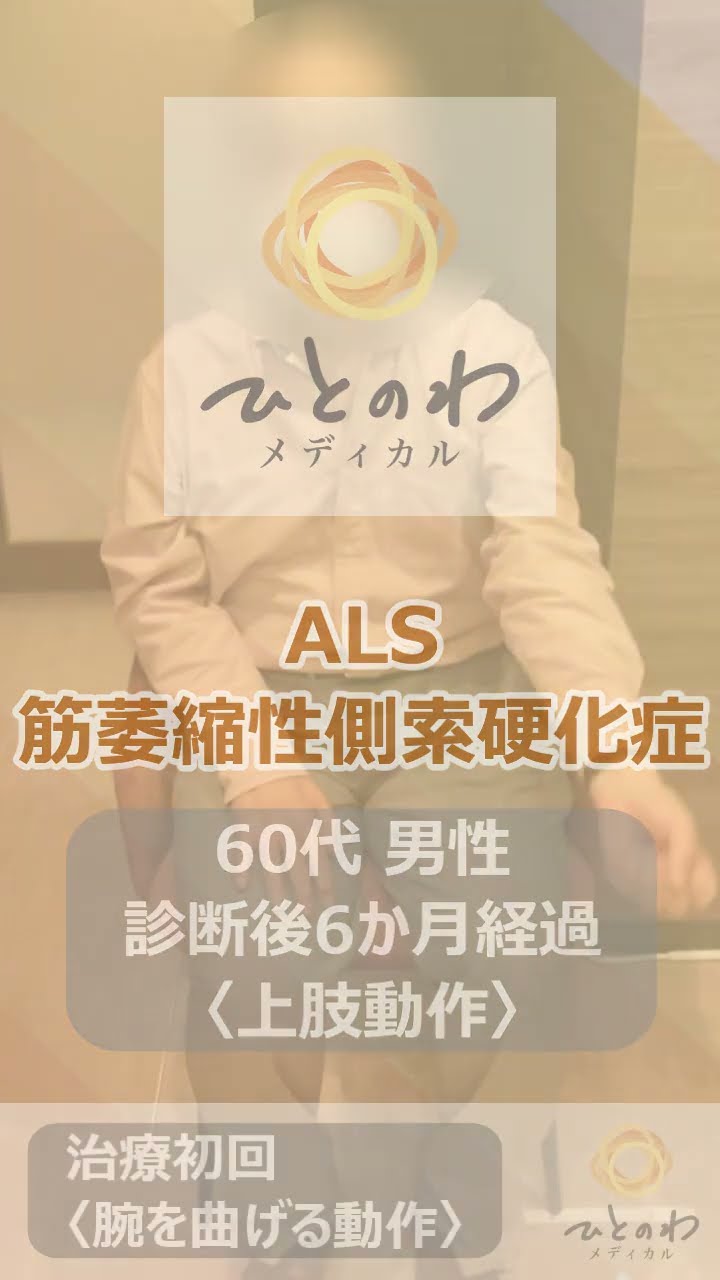 60代男性｜ALSの症例を紹介する動画のサムネイル画像
