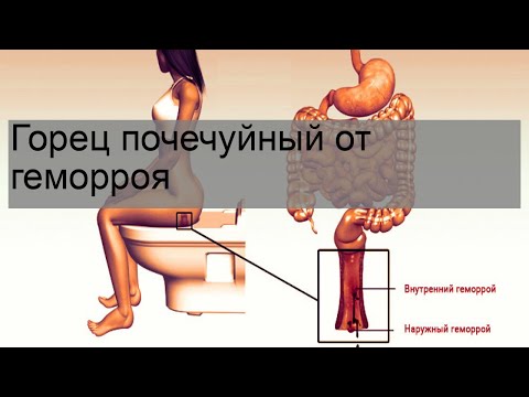 Горец почечуйный от геморроя