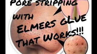 elmers glue for blackheads