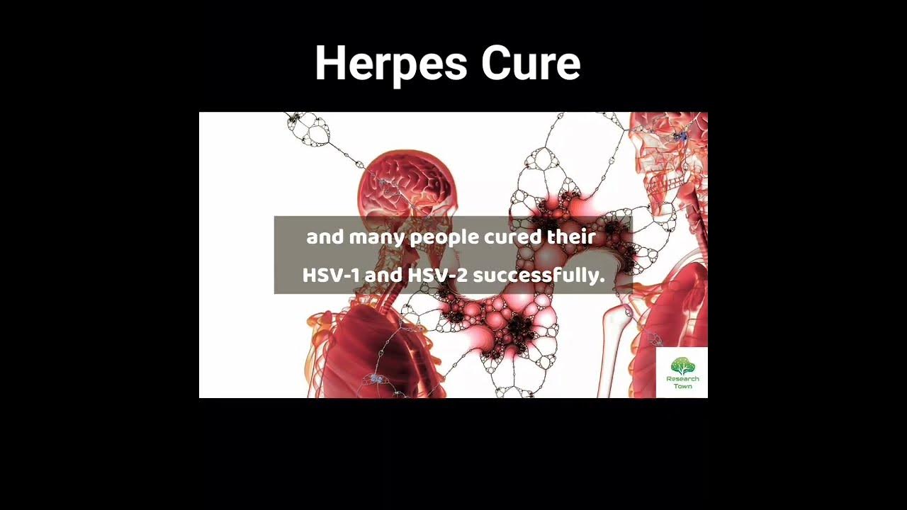 How i cured my hsv 2 herpescure hsv genitalherpes YouTube