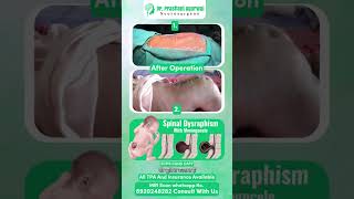 Spinal Dysraphism Solved! See the Life-Changing Surgery.