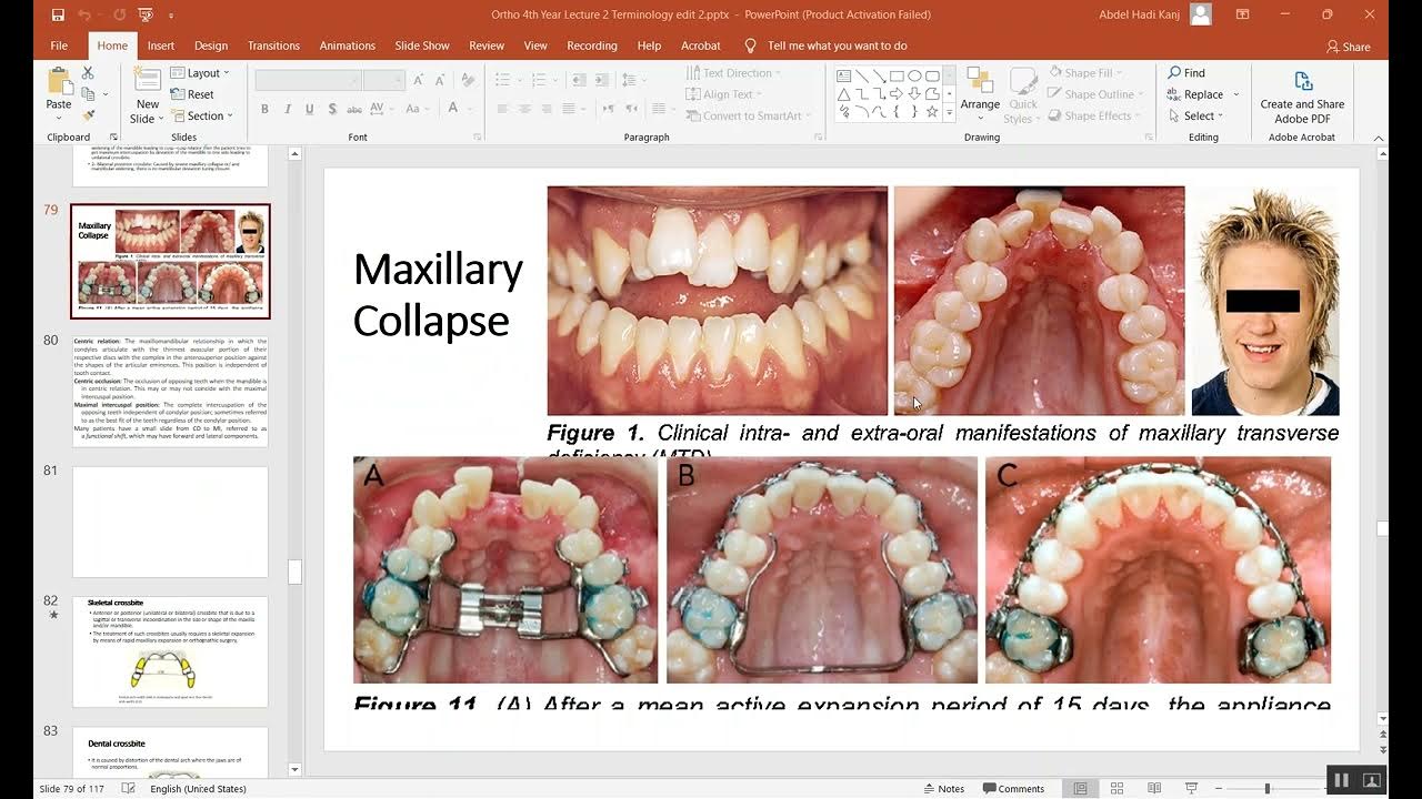 Orthodontic Terminology Part 6 YouTube