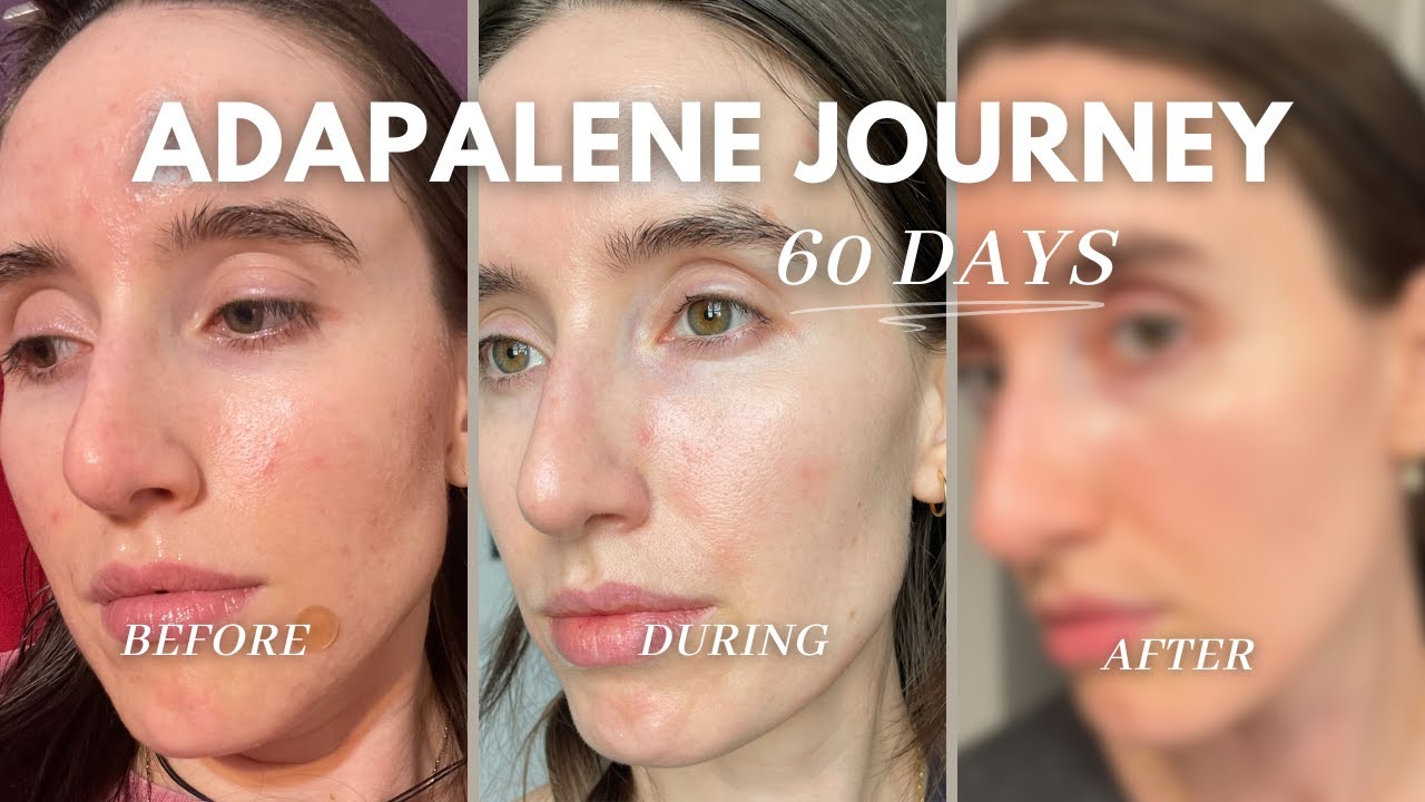 60 Days on Adapalene Results | The Good, the Bad, The Purge