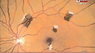 العيادة - د/إيهاب سعد عثمان - فيديو يوضح النقط السوداء في العين - The Clinic