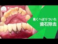 歯医者さんでしてもらう歯石除去で元の綺麗な歯に!! Dental Tartar Removal From the Dentist! 牙医帮您清除牙石让您的牙齿恢復美丽外观!