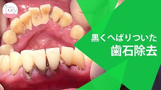 歯医者さんでしてもらう歯石除去で元の綺麗な歯に!! Dental Tartar Removal From the Dentist! 牙医帮您清除牙石让您的牙齿恢復美丽外观!