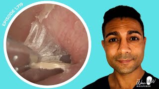 1,719 - Extremely Itchy Ear: Dead Skin Peel
