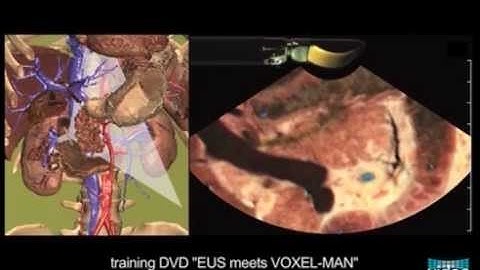 Longitudinal EUS - Anatomical Guiding Structures in the Upper Abdomen (Cranial -- Left)