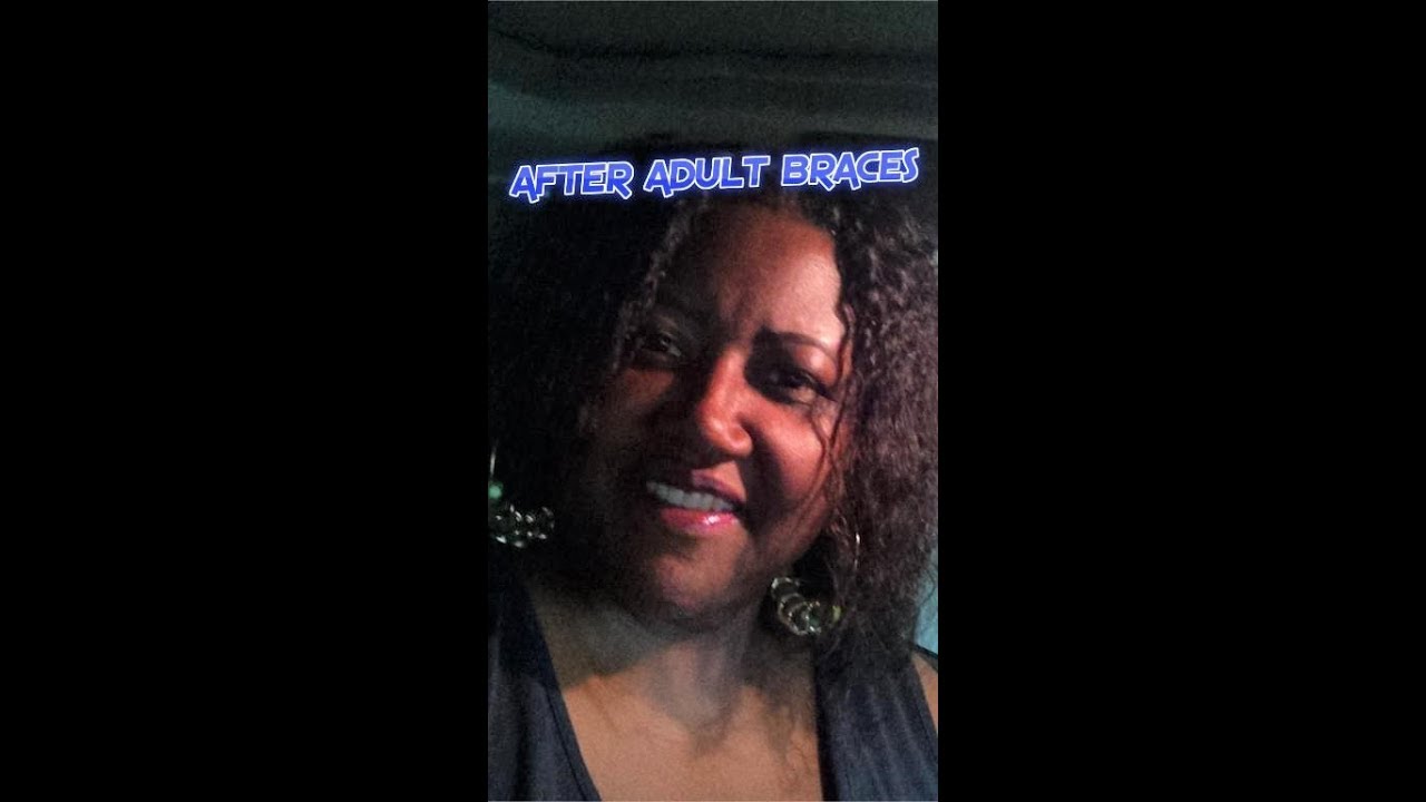 INTEREST-FREE FINANCING    😀    Braces WITHOUT Insurance - YouTube