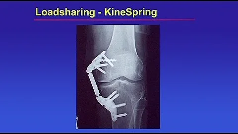 Management of Articular Cartilage Lesions