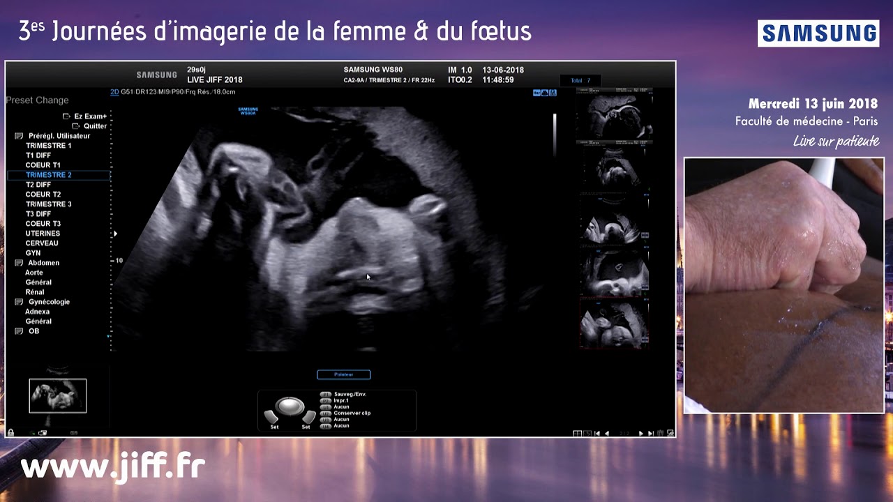 Imagerie foetale - face et des fentes