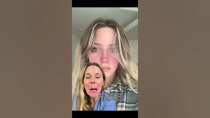 What are your rosacea triggers? Do you primarily get flushing and redness or pimples? #rosacea