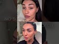Ботулинотерапия💉