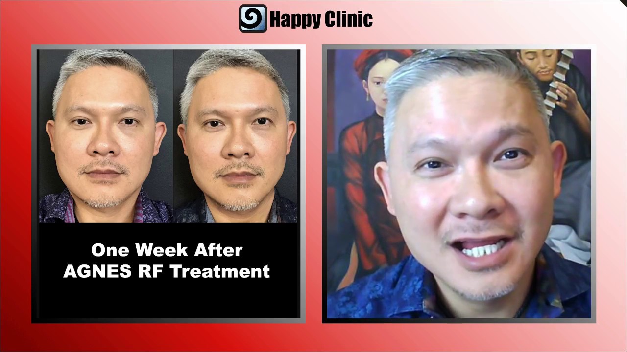 AGNES RadioFrequency (RF) treatment for fat melting and jawline