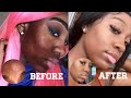 HOW I CLEARED MY ACNE, DARK SPOTS, ACNE SCARS | SKIN CARE ROUTINE