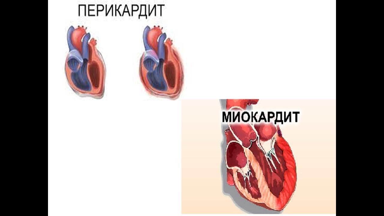 Может Ли Больной Эндокардитом Заниматься Сексом Может Ли Больной Эндокардитом Заниматься Сексом
