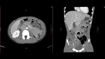 Abdominal Imaging Call Prep Cases: A​p​p​e​n​d​i​c​i​t​i​s​​/A​b​s​c​e​s​s​ ​(​C​T​)  Search Pattern
