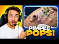 You WON'T Believe What Came Out 😱 | Pimple Popping Reaction