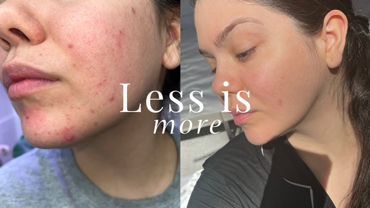 ОТСУТСТВИЕ регулярного ухода за кожей спасло мою кожу