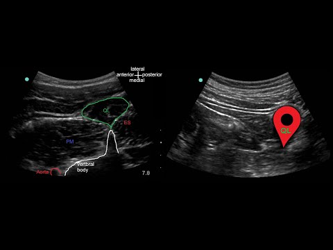 Quadratus Lumborum (QL) block: Ultrasound identification