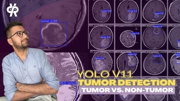 YOLO11 for Tumor Detection: Train on Custom Dataset | Computer Vision