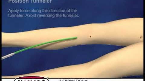Scanlan Vascular Tunneling System