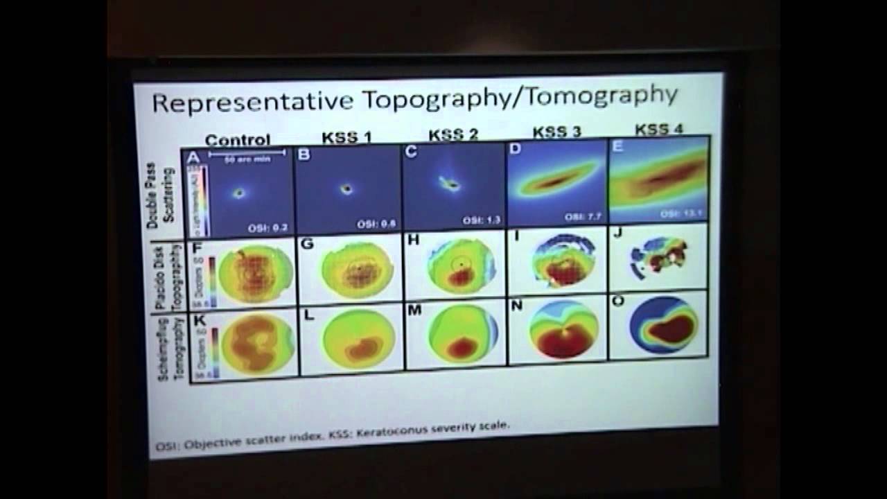 http://clinicaltrials.gov Double-Pass Light Scattering for the Staging and Management of Keratoconus