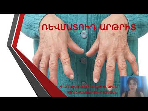 Video: Myasthenia Gravis- ի բուժման 4 եղանակ