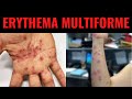 ERYTHEMA MULTIFORME - Triggers, Symptoms, Diagnosis, Treatment - What is Erythema multiforme?