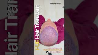 Who will perform my FUE Hair Transplant in Gujrat Pakistan?
