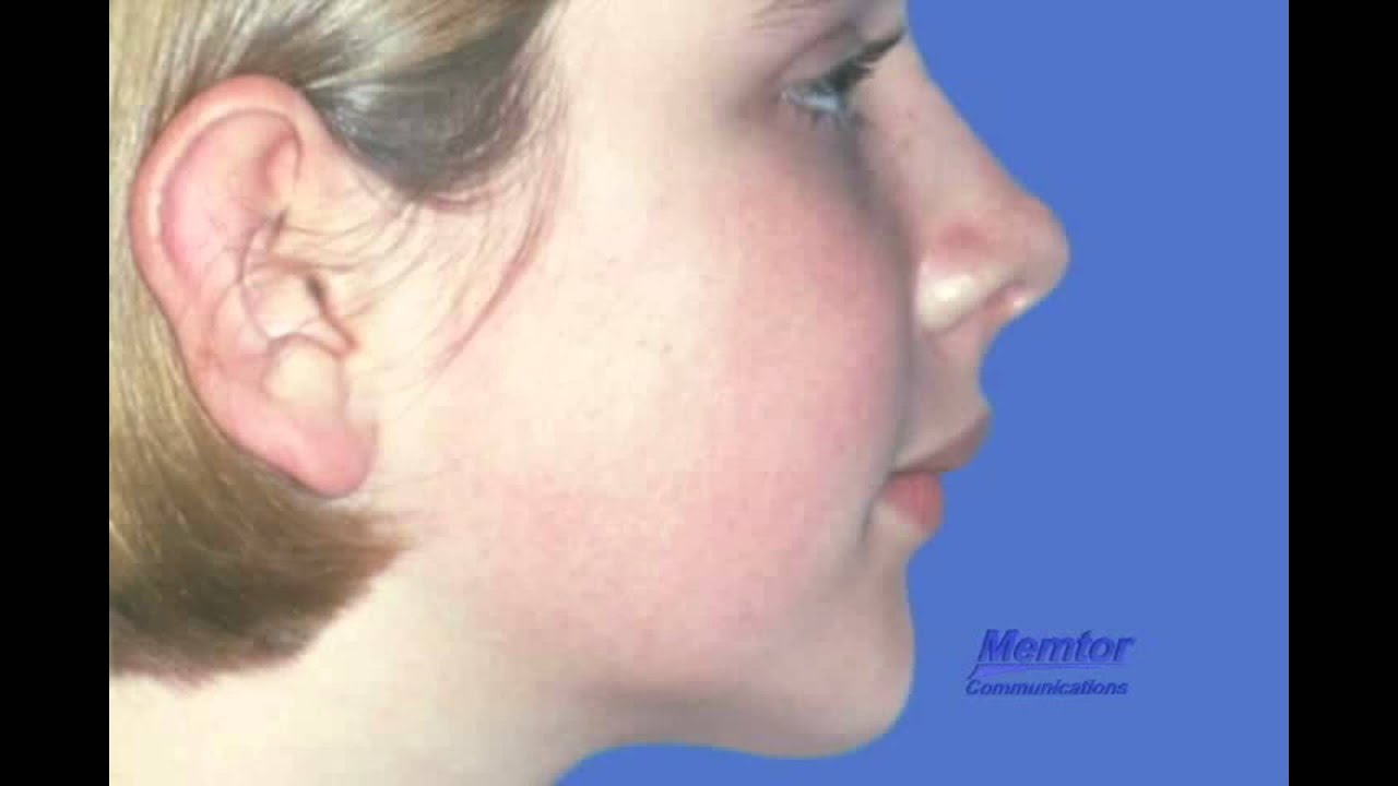 Orthognathic Surgerymandibular advancement YouTube