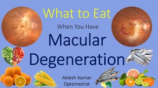 What to Eat When You Have Macular Degeneration | ARMD | Wet ARMD | Dry ARMD