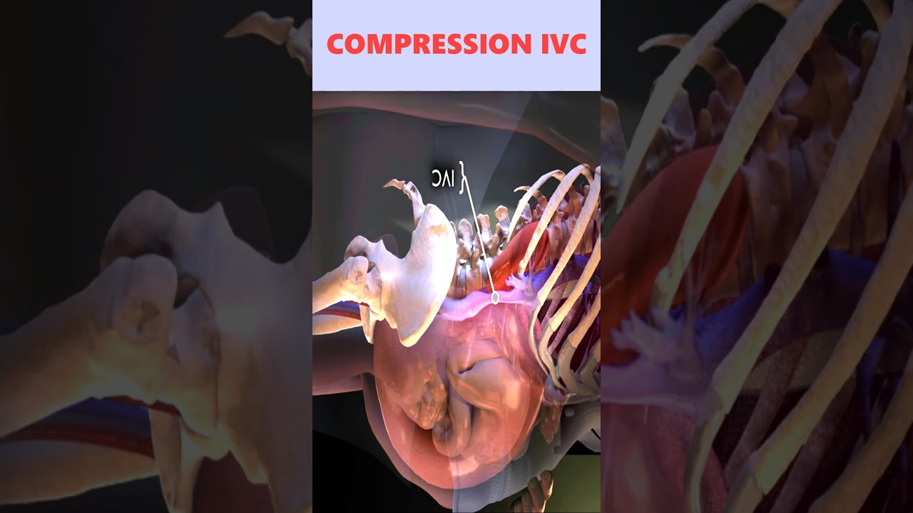 Pregnancy: Prevent Supine Hypotensive Syndrome🤰🏻 