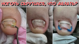видео: СКРУТИЛСЯ НОГОТЬ ЧТО ДЕЛАТЬ? ВРОСШИЙ НОГОТЬ / ТИТАНОВАЯ НИТЬ / ЧАСТЬ 2/ СКРУЧЕННЫЙ НОГОТЬ картинка: СКРУТИЛСЯ НОГОТЬ ЧТО ДЕЛАТЬ? ВРОСШИЙ НОГОТЬ / ТИТАНОВАЯ НИТЬ / ЧАСТЬ 2/ СКРУЧЕННЫЙ НОГОТЬ