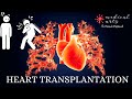 Cardiac Transplantation - Heart Transplantation questions answered, informative educational video