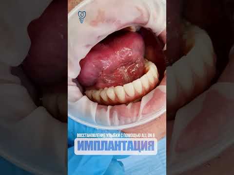 Восстановление улыбки с помощью all on 6. Restoring a smile with all on 6.