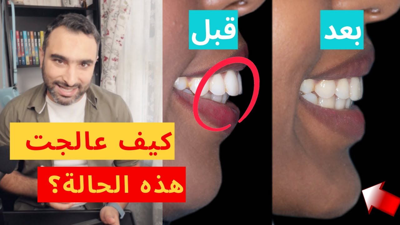 طريقة علاج بروز الفك وتراجع الذقن بدون جراحة | الدكتور محمد صادقلي