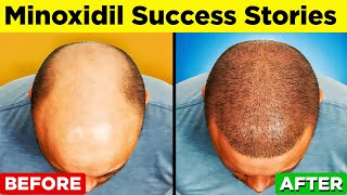 MINOXIDIL - A Step-by-Step Guide to Regain Your Hair