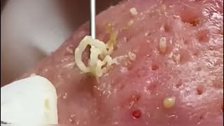Blackheads, Whiteheads, Huge Pores! Cystic acne, Pimple popping.