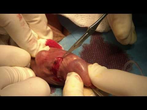 Video: Fimóza - Operácia Fimózy (obriezka)