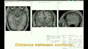 iElectrodes - Implantation planning tutorial