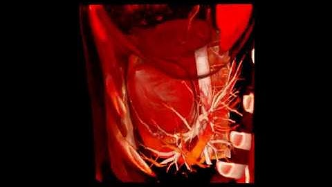 AtomicusChart®: Ray Casting Technique